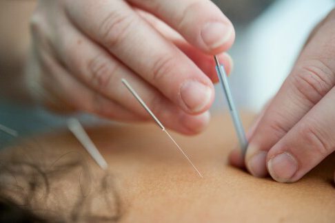 tinywow_rheumhub-acupuncture_74970457