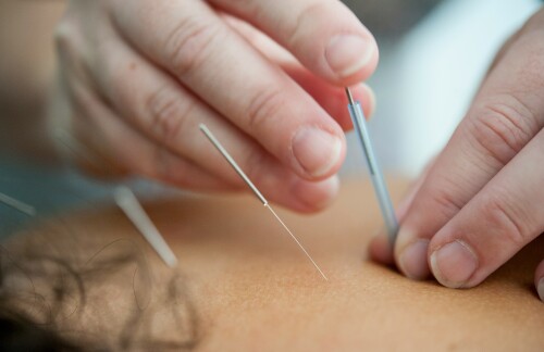 tinywow_rheumhub-acupuncture_74970457